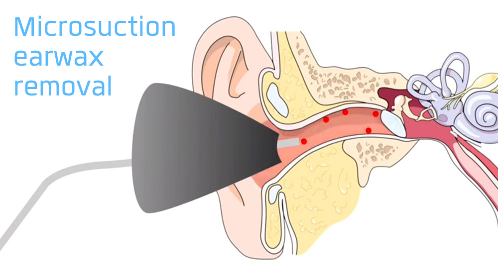 Leeds Ear Treatments Ear Wax Removal The Leeds Clinic