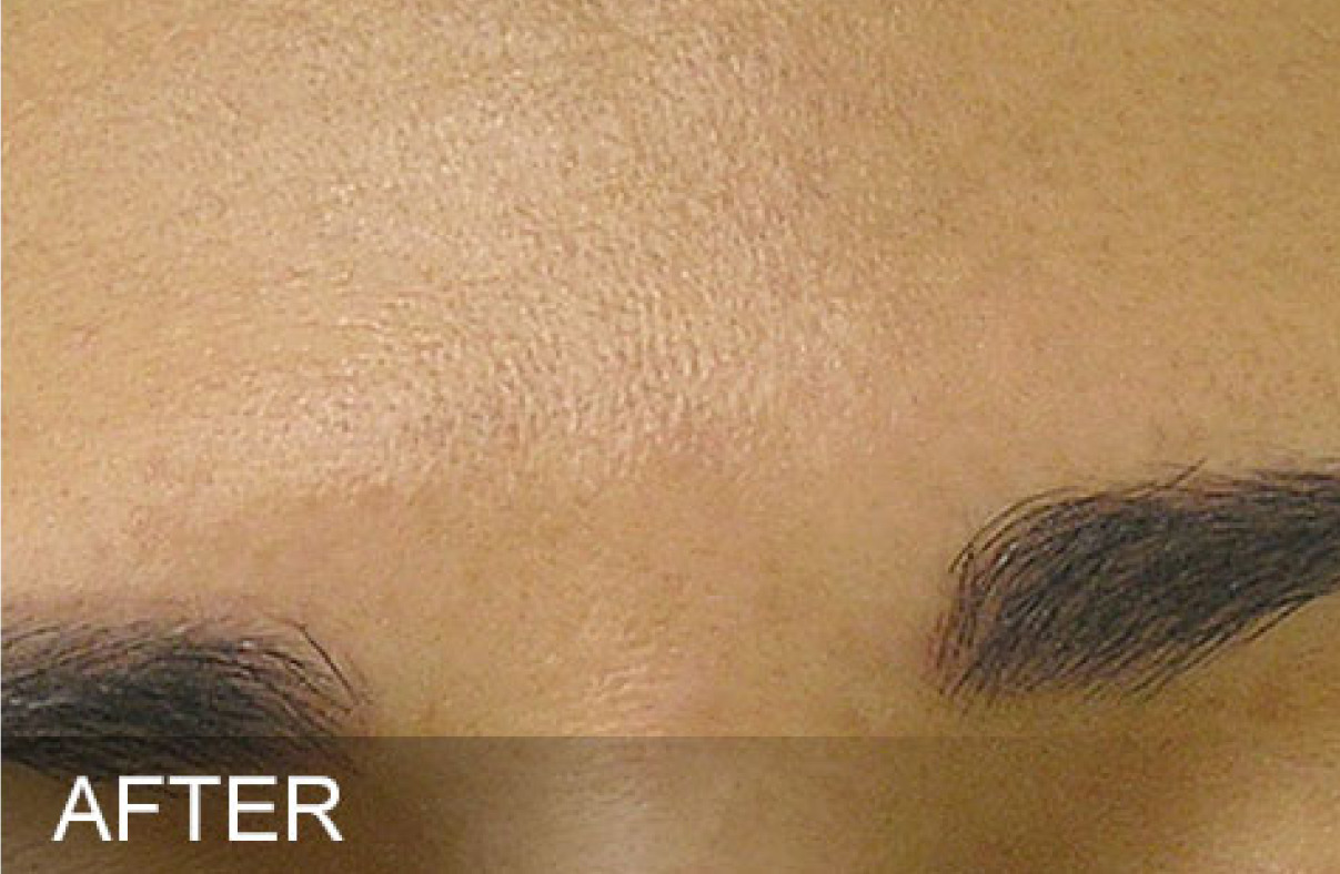 Brown Spots after