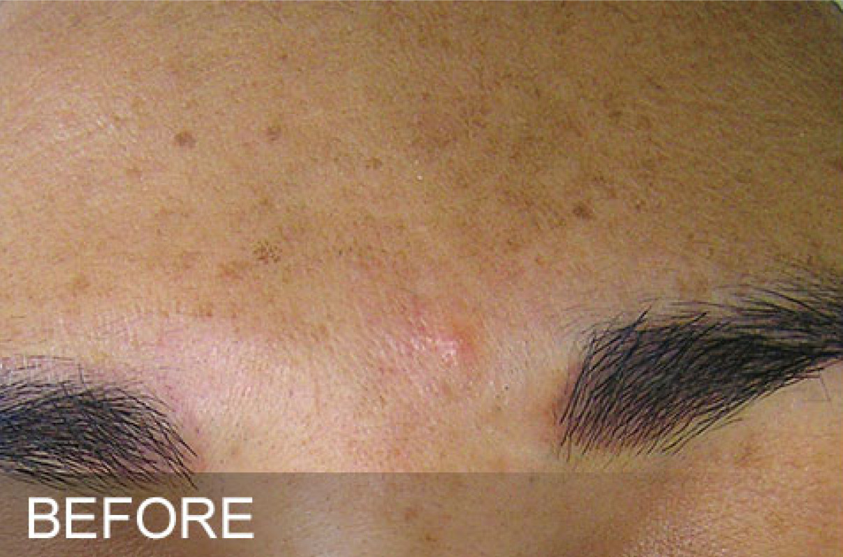 Brown Spots before