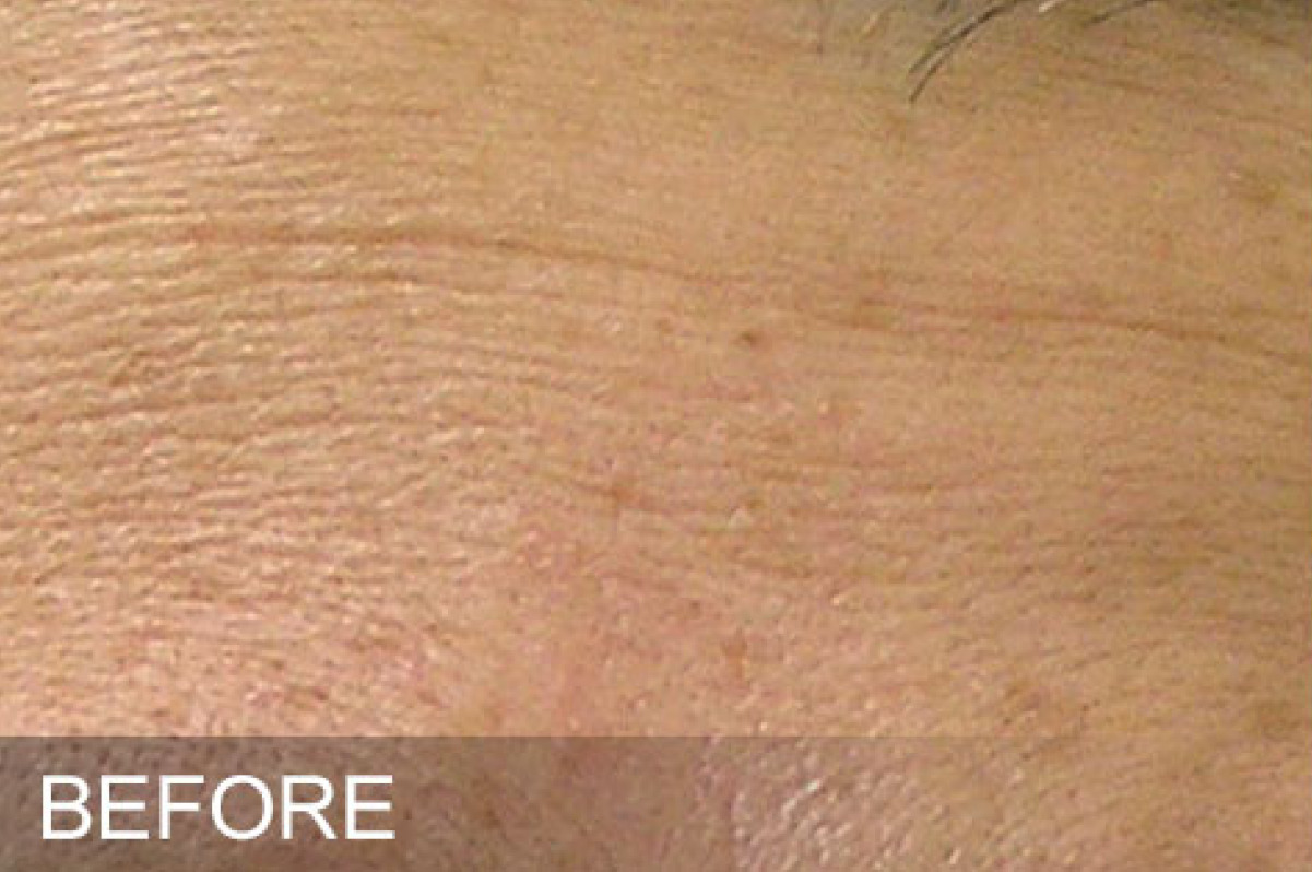 Fine Lines before