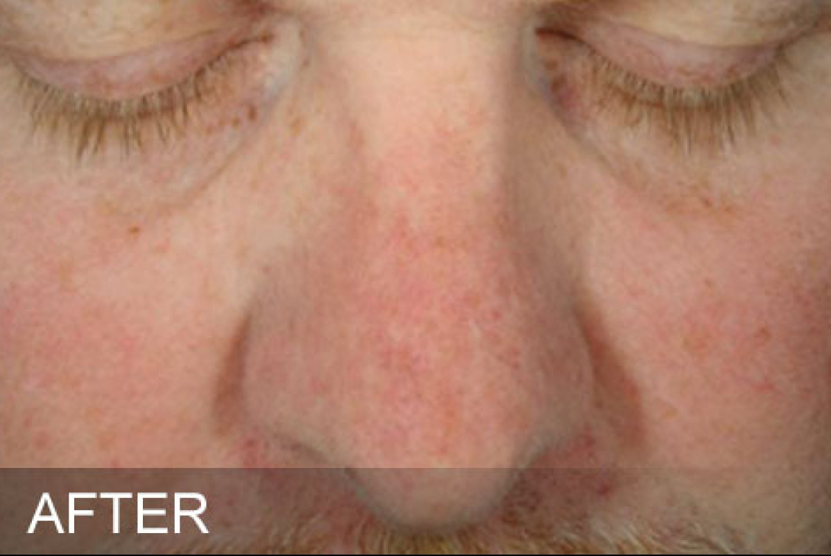Sun Damage after