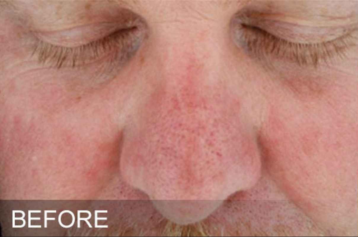 Sun Damage before