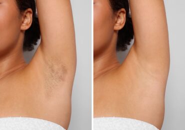laser hair removal treatment guide